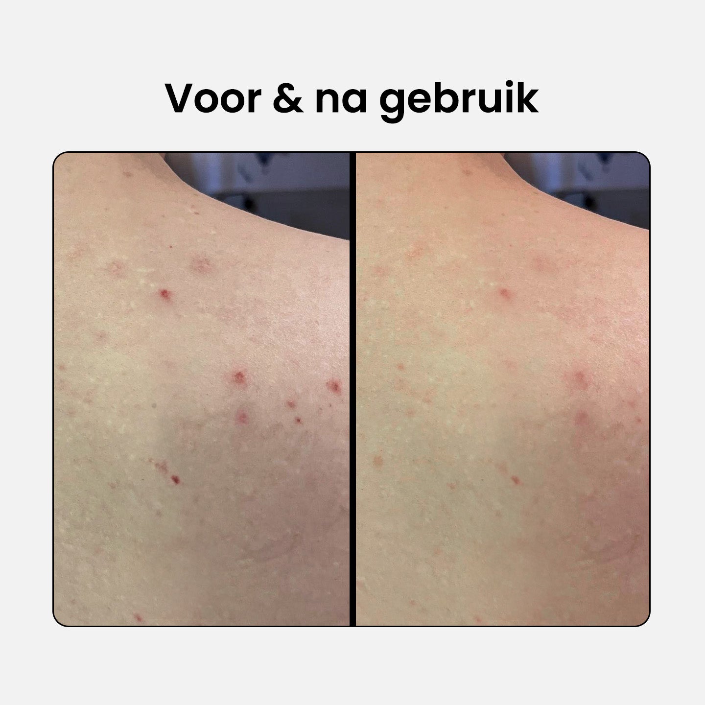 2% BHA Exfoliating Body Spray