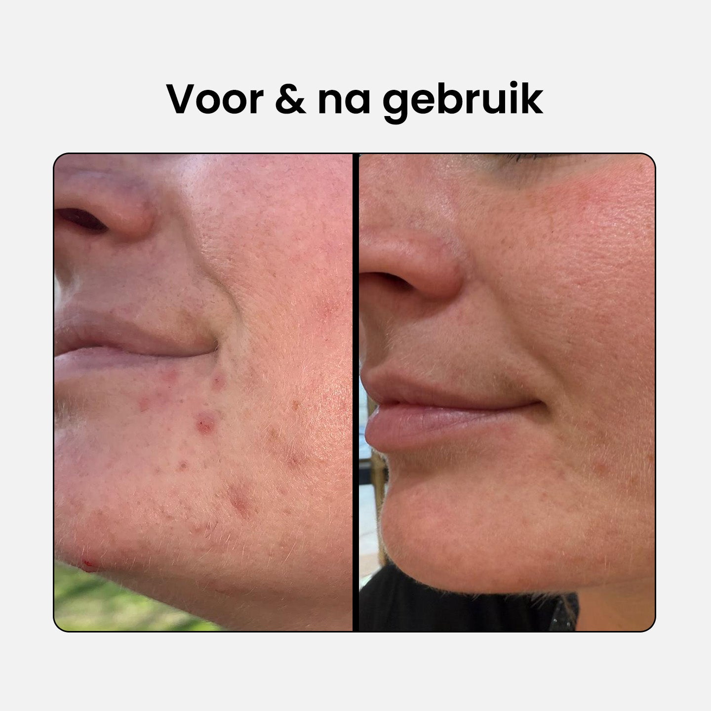 2% BHA Salicylic Acid Serum