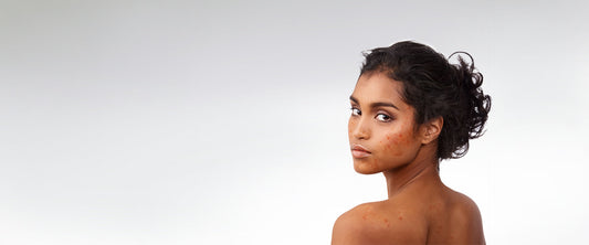 Expertadvies: Bestrijden van de acne met producten van RevitalTrax